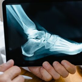 A doctor reviews a foot X-ray on a digital tablet in a medical consultation setting.